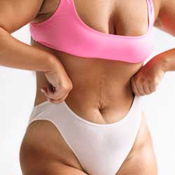 Liposuction Treatments